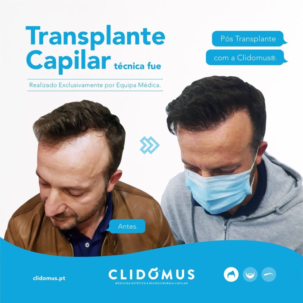 transplante capilar antes e depois
