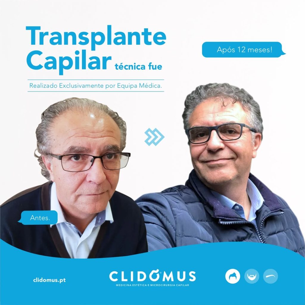transplante capilar antes e depois