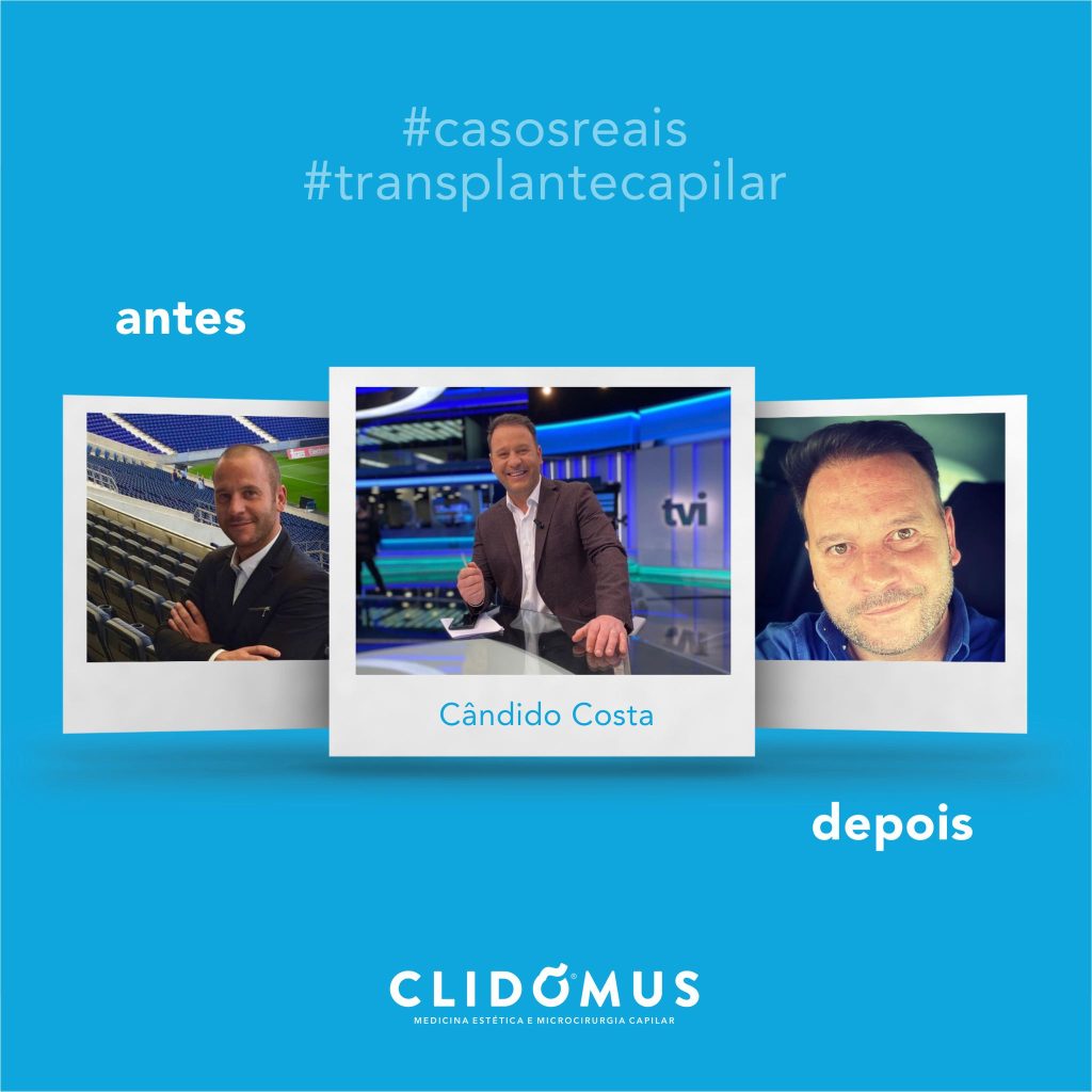transplante capilar candido costa